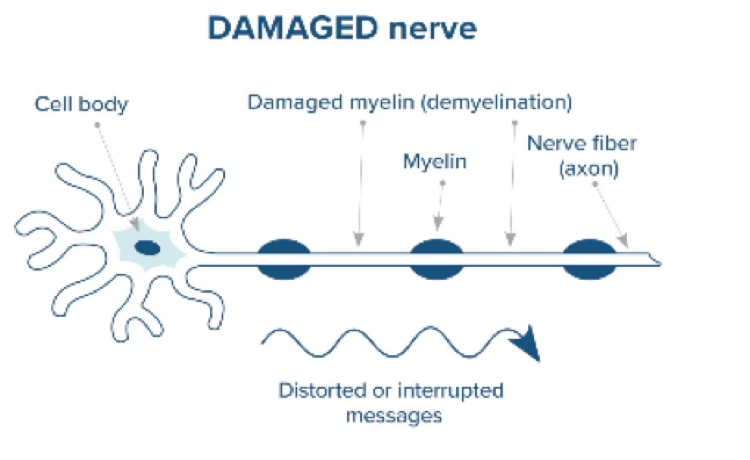 Healthy and damaged nerves